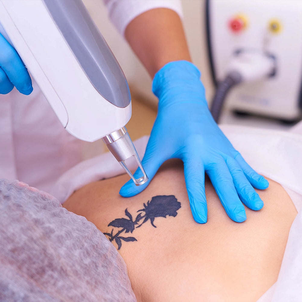 Online Laser Tattoo Removal